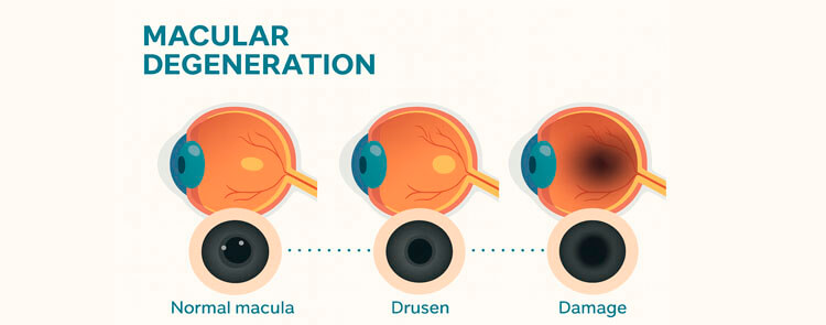 Image WARNING: These 3 Unseen Factors Are Speeding Up Vision Decline
