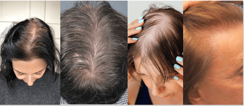 Image 5 Warning Signs Your Hair Is Thinning From Menopause (Especially If You're Over 50)