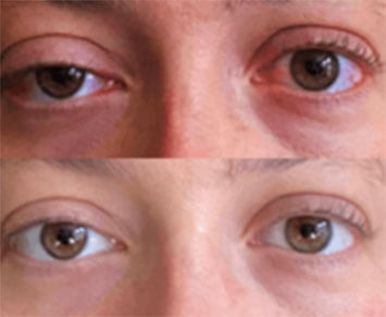 Before After 1