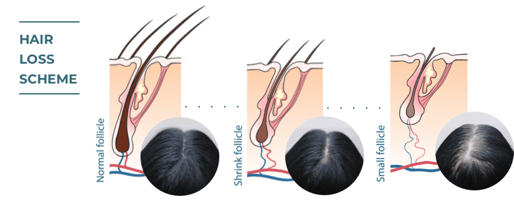 Image Don’t Let Hair Loss Steal Your Confidence