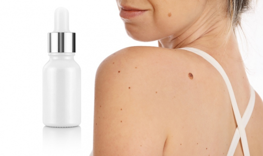 Top 5 Skin Tag Removals